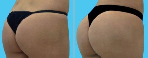 Brazilian Butt Lift | Atlanta | Before and After Photos | Dr. Marcia Byrd