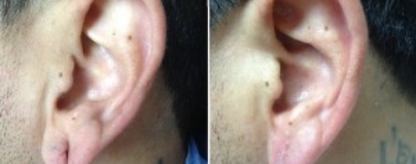 Earlobe Repair | Atlanta | Before and After Photos | Dr. Marcia Byrd