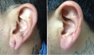 Earlobe Repair | Atlanta | Before and After Photos | Dr. Marcia Byrd