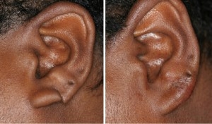 Earlobe Repair | Atlanta | Before and After Photos | Dr. Marcia Byrd