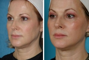 Erbium Laser | Atlanta | Before and After Photos | Dr. Marcia Byrd