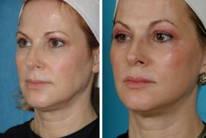 Erbium Laser | Atlanta | Before and After Photos | Dr. Marcia Byrd