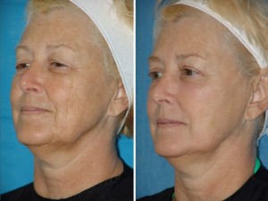 | Atlanta | Before and After Photos | Dr. Marcia Byrd