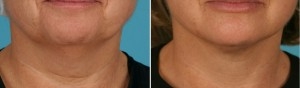 Mini Facelift | Atlanta | Patient 1 | Before and After Photos | Front View | Dr. Marcia Byrd