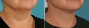 Facial Laser Lift | Atlanta | Patient 1 | Before and After Photos | Oblique View | Dr. Marcia Byrd