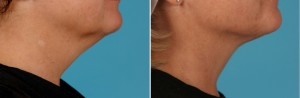 Facial Laser Lift | Atlanta | Patient 1 | Before and After Photos | Side View | Dr. Marcia Byrd