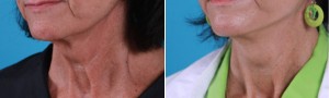 | Atlanta | Before and After Photos | Dr. Marcia Byrd