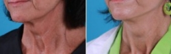 Facial Laser Lift | Atlanta | Patient 2 | Before and After Photos | Oblique View | Dr. Marcia Byrd