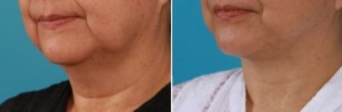 Facial Laser Lift | Atlanta | Patient 1 | Before and After Photos | Front View | Dr. Marcia ByrdFacial Laser Lift | Atlanta | Patient 1 | Before and After Photos | Oblique View | Dr. Marcia Byrd