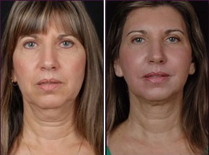 Facial Laser Lift | Atlanta | Patient 4 | Before and After Photos | Front View | Dr. Marcia Byrd|