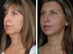 Facial Laser Lift | Atlanta | Patient 4 | Before and After Photos | Oblique View | Dr. Marcia Byrd