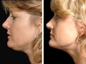 Facial Laser Lift  | Atlanta | Before and After Photos | Dr. Marcia Byrd