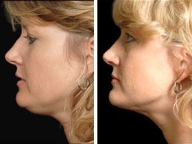 Facial Laser Lift | Atlanta | Before and After Photos | Dr. Marcia Byrd