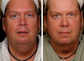 Facial Laser Lift | Atlanta | Before and After Photos | Dr. Marcia Byrd