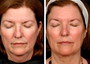 Facial Laser Lift | Atlanta | Patient 9 | Before and After Photos | Front View | Dr. Marcia Byrd