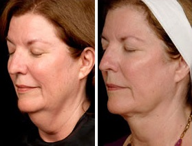 Facial Laser Lift | Atlanta | Patient 9 | Before and After Photos | Oblique View | Dr. Marcia Byrd