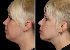 Facial Laser Lift | Atlanta | Patient 8 | Before and After Photos | Side View | Dr. Marcia Byrd