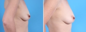 Fat Transfer Breasts | Atlanta | Before and After Photos | Dr. Marcia Byrd