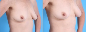 Fat Transfer Breasts | Atlanta | Before and After Photos | Dr. Marcia Byrd