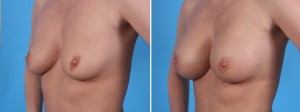 Fat Transfer Breasts | Atlanta | Before and After Photos | Dr. Marcia Byrd