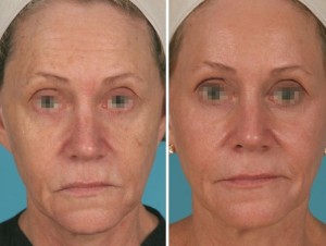 | Atlanta | Before and After Photos | Dr. Marcia Byrd