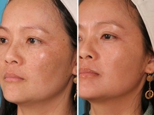 Fraxel Laser | Atlanta | Before and After Photos | Dr. Marcia Byrd