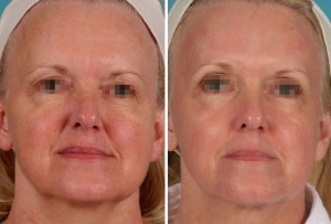 | Atlanta | Before and After Photos | Dr. Marcia Byrd