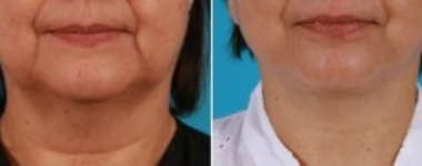 | Atlanta | Before and After Photos | Dr. Marcia Byrd