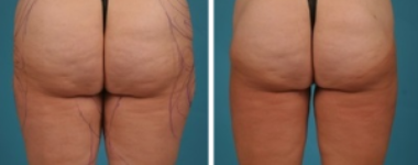 Water Assisted Liposuction | Atlanta | Lipedema| Before and After Photos | Dr. Marcia Byrd