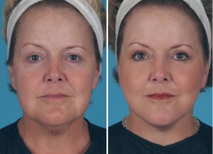 Mini Facelift | Atlanta | Patient 1 | Before and After Photos | Front View | Dr. Marcia Byrd