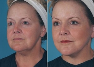 Mini Facelift | Atlanta | Patient 1 | Before and After Photos | Oblique View | Dr. Marcia Byrd