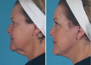 Mini Facelift | Atlanta | Patient 1 | Before and After Photos | Side View | Dr. Marcia Byrd