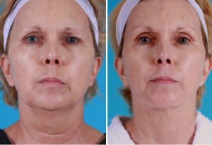 | Atlanta | Before and After Photos | Dr. Marcia Byrd