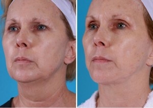 Mini Facelift | Atlanta | Patient 2 | Before and After Photos | Oblique View | Dr. Marcia Byrd