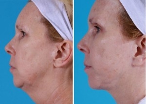 Mini Facelift | Atlanta | Patient 2 | Before and After Photos | Side View | Dr. Marcia Byrd