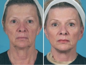 Mini Facelift | Atlanta | Patient 3 | Before and After Photos | Front View | Dr. Marcia Byrd