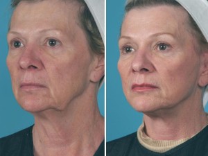 Mini Facelift | Atlanta | Patient 3 | Before and After Photos | Oblique View | Dr. Marcia Byrd