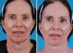 Mini Facelift | Atlanta | Patient 4 | Before and After Photos | Front View | Dr. Marcia Byrd