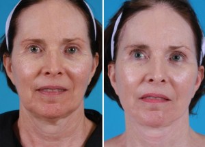 Mini Facelift | Atlanta | Patient 4 | Before and After Photos | Front View | Dr. Marcia Byrd