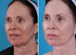 Mini Facelift | Atlanta | Patient 4 | Before and After Photos | Oblique View | Dr. Marcia Byrd