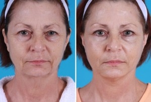 Mini Facelift | Atlanta | Patient 5 | Before and After Photos | Front View | Dr. Marcia Byrd