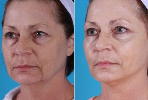 Mini Facelift | Atlanta | Patient 5 | Before and After Photos | Oblique View | Dr. Marcia Byrd
