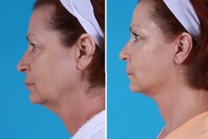 Mini Facelift | Atlanta | Patient 5 | Before and After Photos | FSide View | Dr. Marcia Byrd