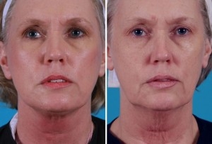 Mini Facelift | Atlanta | Patient 6 | Before and After Photos | Front View | Dr. Marcia Byrd