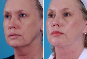 Mini Facelift | Atlanta | Patient 6 | Before and After Photos | Olique View | Dr. Marcia Byrd