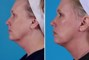 Mini Facelift | Atlanta | Patient 6 | Before and After Photos | Side View | Dr. Marcia Byrd