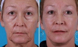 Mini Facelift | Atlanta | Patient 7 | Before and After Photos | Front View | Dr. Marcia Byrd