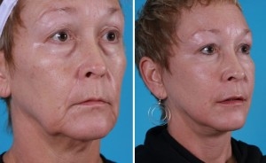 Mini Facelift | Atlanta | Patient 7 | Before and After Photos | Oblique View | Dr. Marcia Byrd