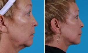 Mini Facelift | Atlanta | Patient 7 | Before and After Photos | Side View | Dr. Marcia Byrd