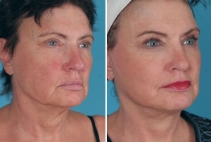 Mini Facelift | Atlanta | Patient 8 | Before and After Photos | Oblique View | Dr. Marcia Byrd